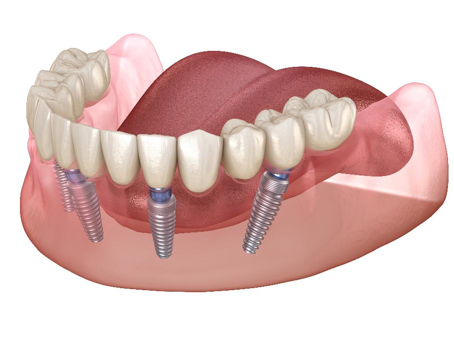 all-on-x dental implants in reservoir